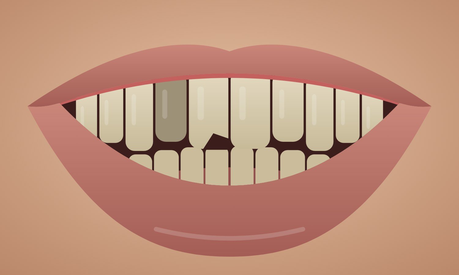 Before: chipped, worn and discoloured teeth